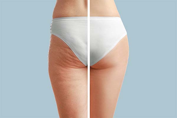 Will Thigh Lift Surgery Remove Cellulite? - Artesia Plastic Surgery  Williamsville, NY